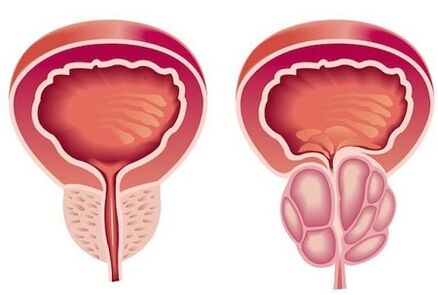 Symptoms of prostatitis in men